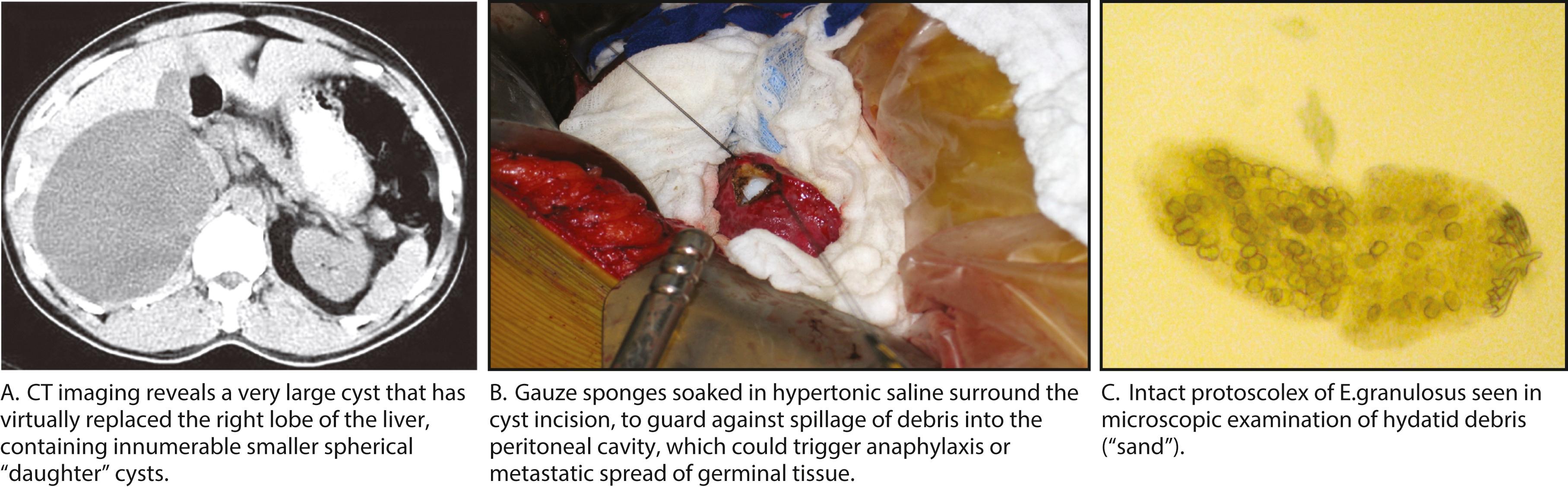 Fig. 45.1, Multicystic echinococcosis.