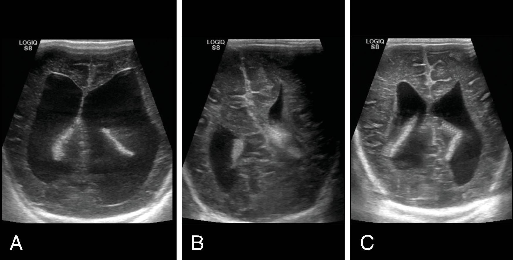 Fig. 11.12, Shunt Malfunction . (A) Coronal head ultrasound image of a newborn with Chiari II malformation and hydrocephalus. (B) Follow-up head ultrasound following shunt placement (arrow) shows smaller ventricles. (C) Follow-up head ultrasound at 1 month of age shows interval enlargement of the ventricles, indicating a shunt malfunction.