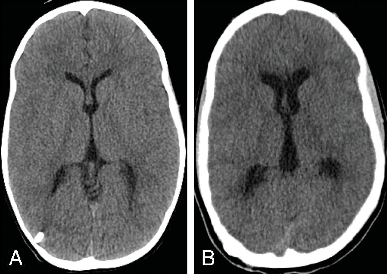 Fig. 11.13, Shunt Malfunction . (A) Baseline axial head CT image at 4 years of age shows a right posterior approach shunt catheter and normal ventricular size. (B) At age 10 the patient presented with headache and vomiting for 3 days. Head CT image shows interval enlargement of the ventricles and mild transependymal edema, indicating a shunt malfunction.