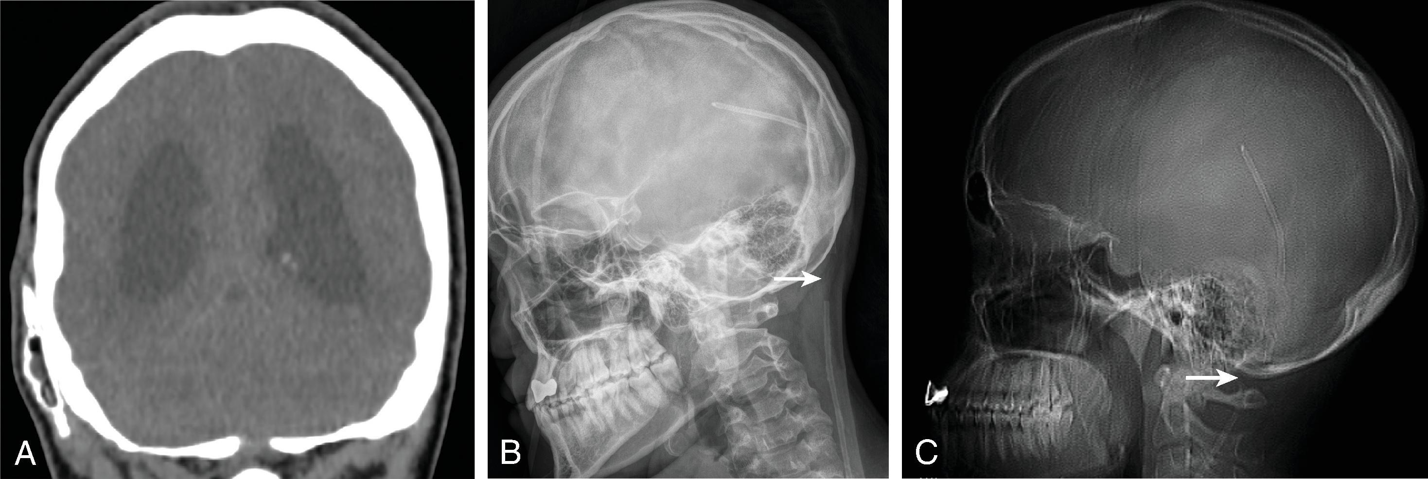 Fig. 11.14, Shunt Malfunction . An 18-year-old with past history of prematurity, germinal matrix and intraventricular hemorrhage, and shunted hydrocephalus. (A) Coronal head CT demonstrates enlarged ventricles and disconnected shunt tubing, which is also confirmed on (B) lateral shunt radiograph (arrow) . (C) The disconnection is also seen on the localizer image of the CT, which is a reminder to view the localizer images for additional findings not covered in the CT dataset.