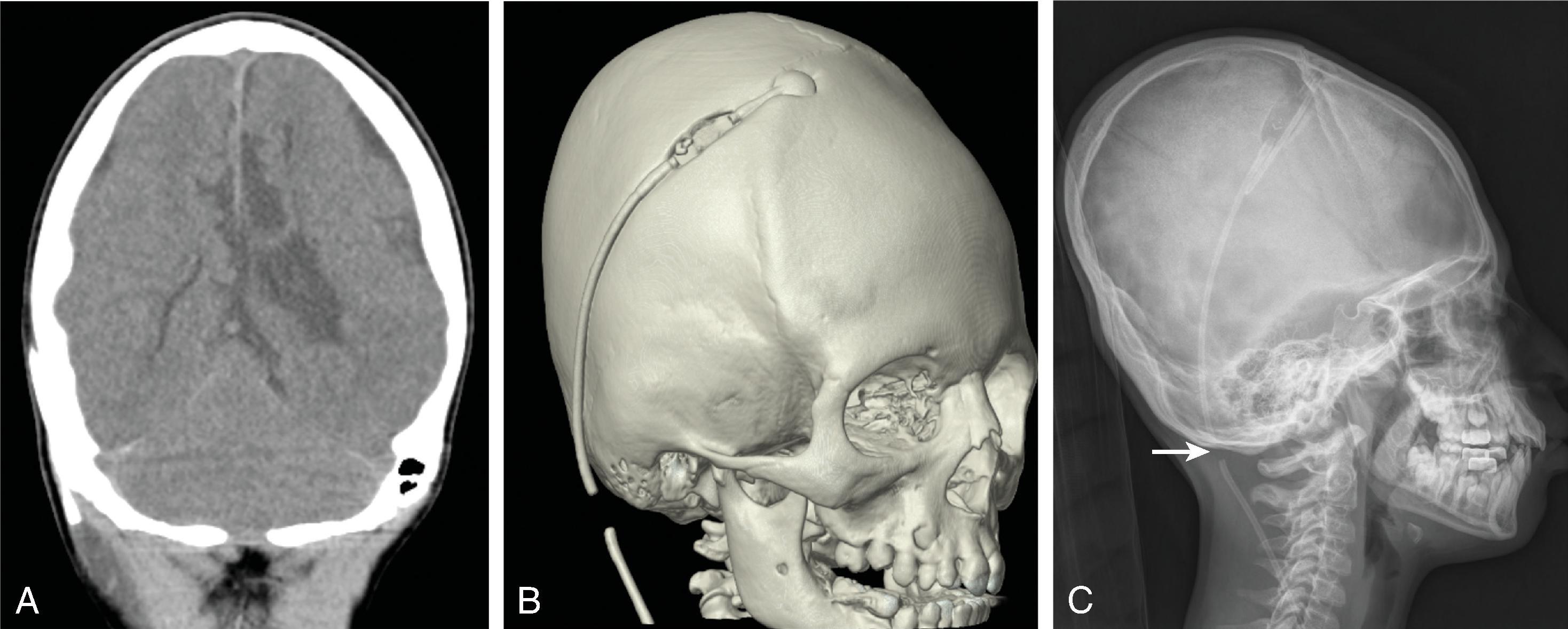 Fig. 11.15, Shunt Malfunction . (A) Coronal head CT, (B) 3D CT volume reconstruction, and (C) lateral shunt radiograph demonstrating shunt tubing fracture and separation (arrow) .