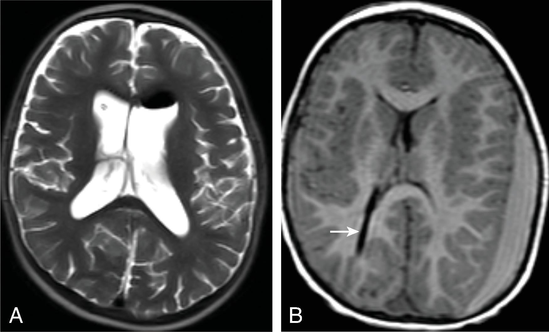 Fig. 11.16, Shunt Complication . (A) Axial T2W image at time of initial shunt placement. Air in the frontal horn of the left lateral ventricle is related to the shunt placement. (B) Follow-up MRI axial T1W image demonstrates an interval decrease in ventricular size, nearly slit-like, and development of a T1W hyperintense left lateral subdural hematoma caused by over shunting of CSF.