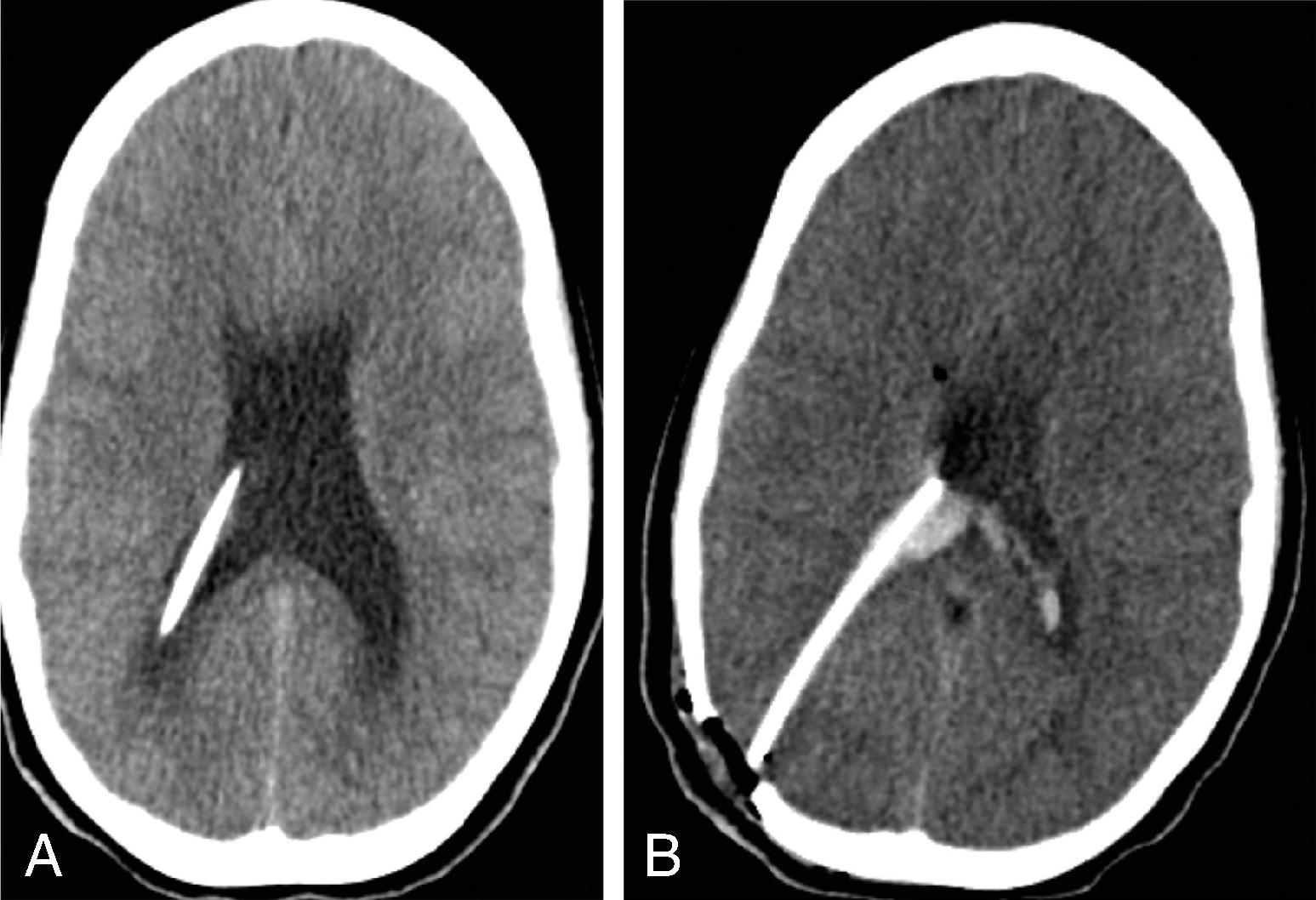 Fig. 11.17, Shunt Revision Complication . (A) Axial CT head prior to shunt revision. (B) Axial CT head with revision of the shunt and new intraventricular hemorrhage.