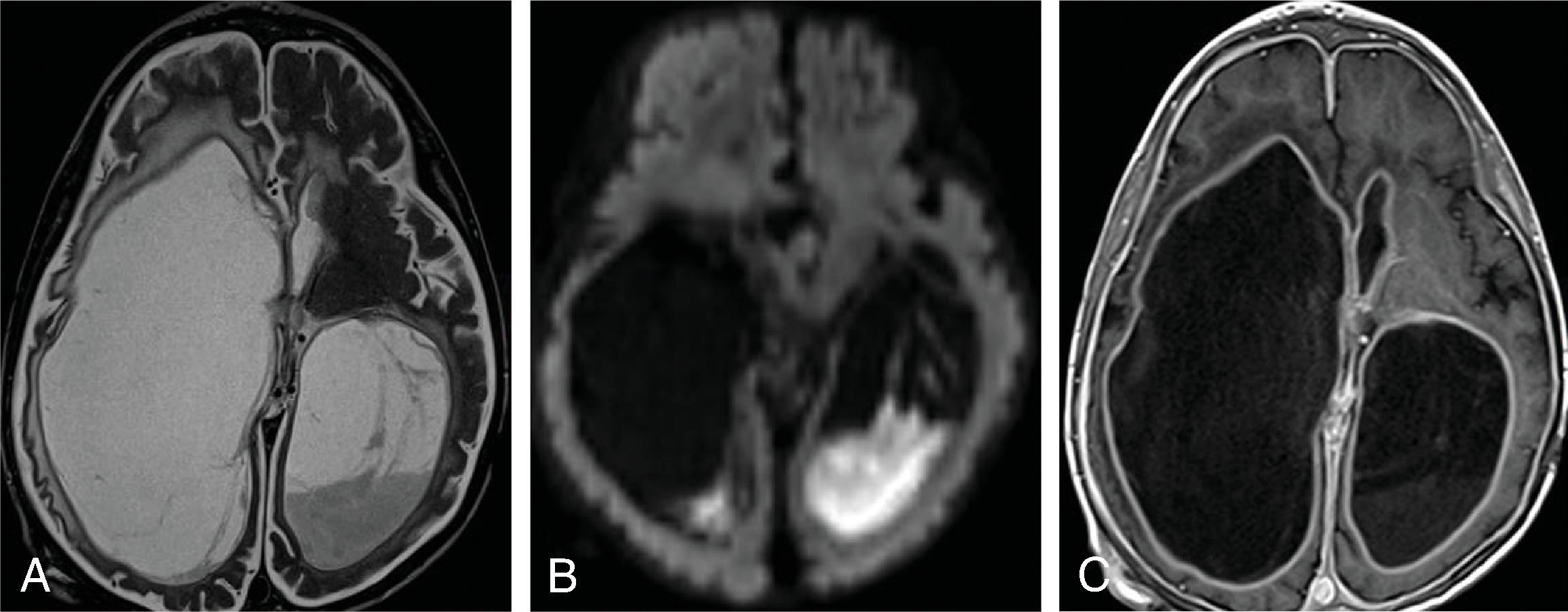 Fig. 11.18, Shunt Infection . (A) Axial T2W, (B) axial DWI, and (C) axial T1W+C images demonstrate disproportionate ventricular enlargement, ependymal enhancement, intraventricular septations, diffusion restricting purulent material in the atria of the ventricles, and periventricular edema.