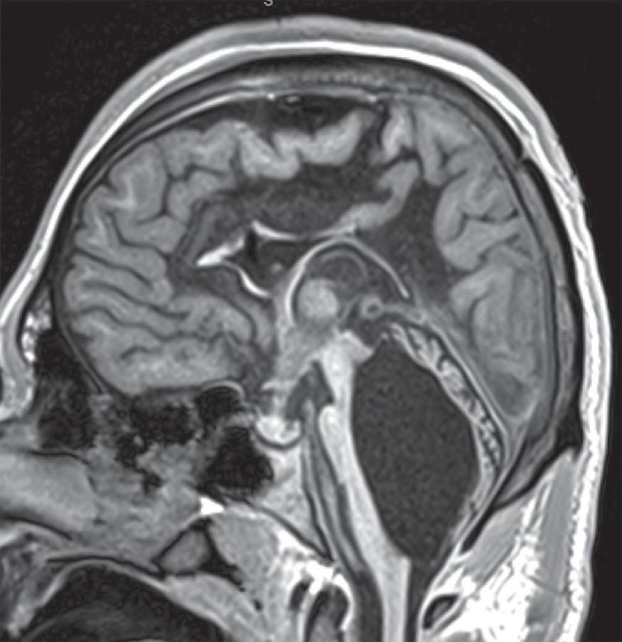 Fig. 11.19, Trapped Fourth Ventricle . An 18-year-old with prematurity and shunted hydrocephalus. Sagittal T1W image demonstrates a distended fourth ventricle following decompression of the lateral ventricles. The fourth ventricle compresses the brainstem and cerebellum.