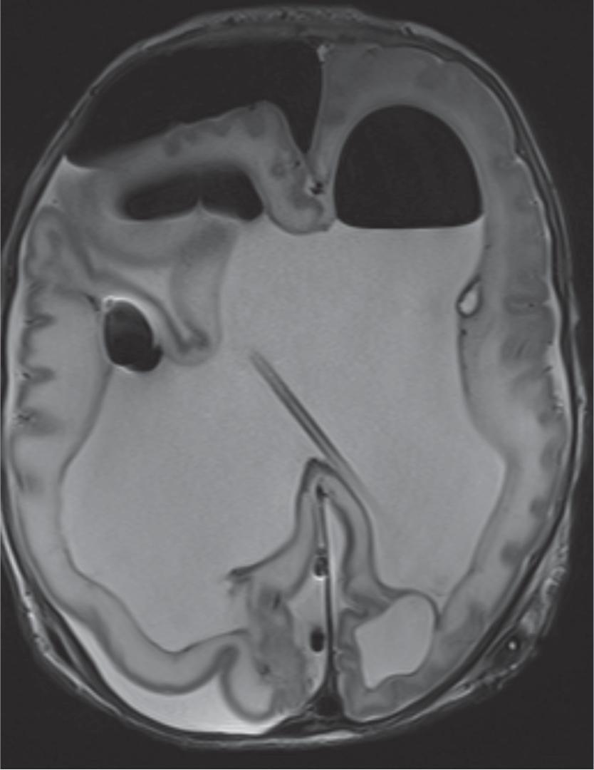 Fig. 11.20, Cortical Mantle Infolding Following Shunt Placement . Axial T2W image demonstrates cortical infolding in the right cerebral hemisphere.