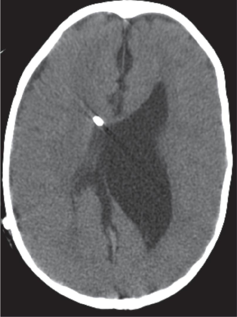 Fig. 11.21, Slit-Like Ventricle Syndrome . Axial CT head demonstrates a slit-like right lateral ventricle and an enlarged left lateral ventricle.