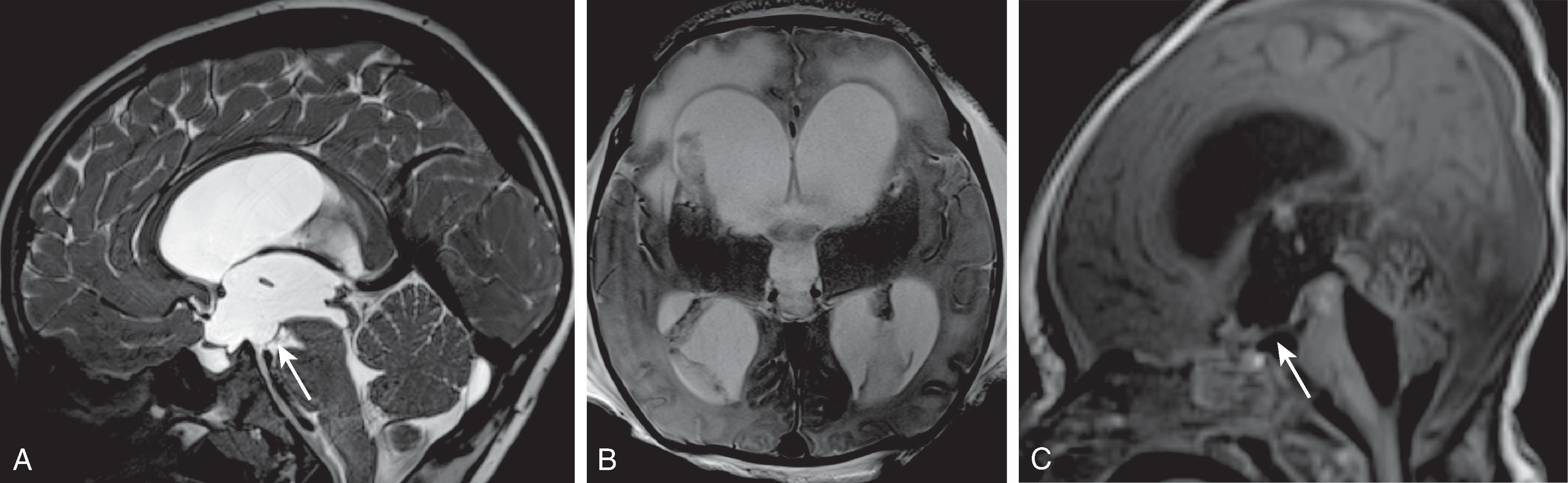 Fig. 11.3, Hydrocephalus Imaging Findings . (A) Sagittal T2W image in a patient with inferior aqueductal stenosis demonstrates inferior bowing of the third ventricle ( arrow ) with dilatation of the recesses of the third ventricle and stretching of the corpus callosum. (B) Axial T2W image in a patient with meningitis demonstrates disproportionate enlargement of the lateral and third ventricles relative to the sulci and parenchymal edema. (C) Sagittal T1W image demonstrating hydrocephalus findings of inferior bowing of the third ventricle with dilatation of the recesses of the third ventricle, stretching of the corpus callosum, enlarged fourth ventricle, and an adhesion at the foramen of Magendie obstructing CSF outflow.