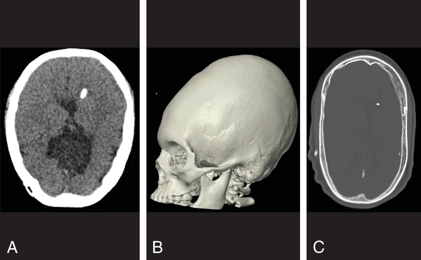 Fig. 11.22, Skull Thickening and Abnormal Calvarial Shape . (A and B) Axial CT and 3D reformat CT demonstrate calvarial thickening, microcephaly, and flattening of the frontal bones due to chronic shunting in a 12-year-old patient with prematurity-related hydrocephalus. (C) Axial head CT in a 13-year-old with shunted hydrocephalus demonstrates scaphocephaly due to chronic shunting.