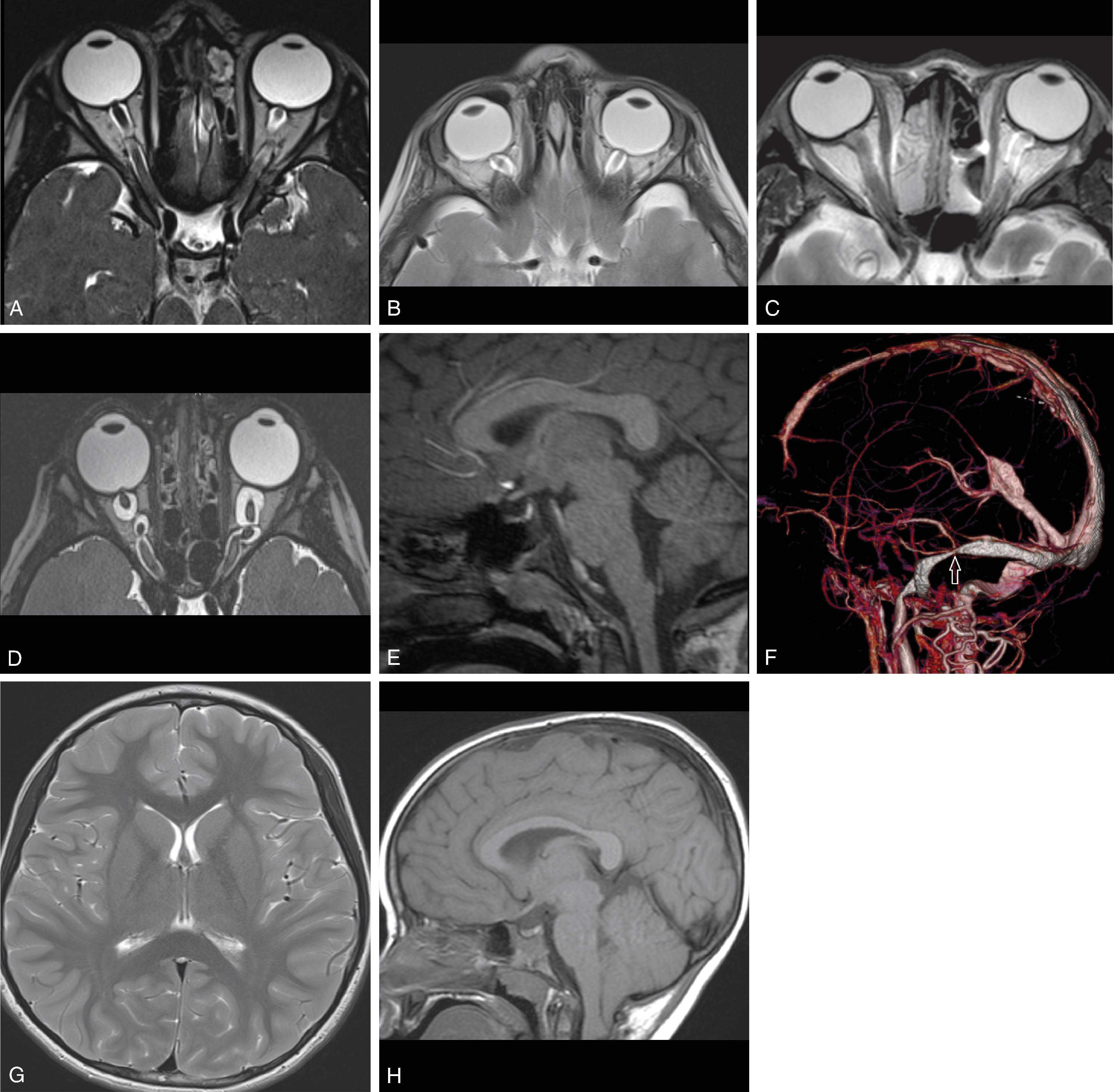 Fig. 11.23, Idiopathic Intracranial Hypertension . (A) Axial 3D T2W image with bulging of the optic discs indicative of papilledema. (B) Axial T2W image demonstrating optic nerve sheath dilatation. (C) Axial T2W image demonstrating posterior globe flattening. (D) Axial 3D T2W image demonstrating optic nerve tortuosity. (E) Sagittal T1W image with partially empty sella indicative of elevated intracranial pressure. (F) CT venogram volume rendered image demonstrating focal stenosis of the transverse sinus. (G) Axial T2W image demonstrating slit-like ventricles. (H) Sagittal T1W image demonstrating low cerebellar tonsils.