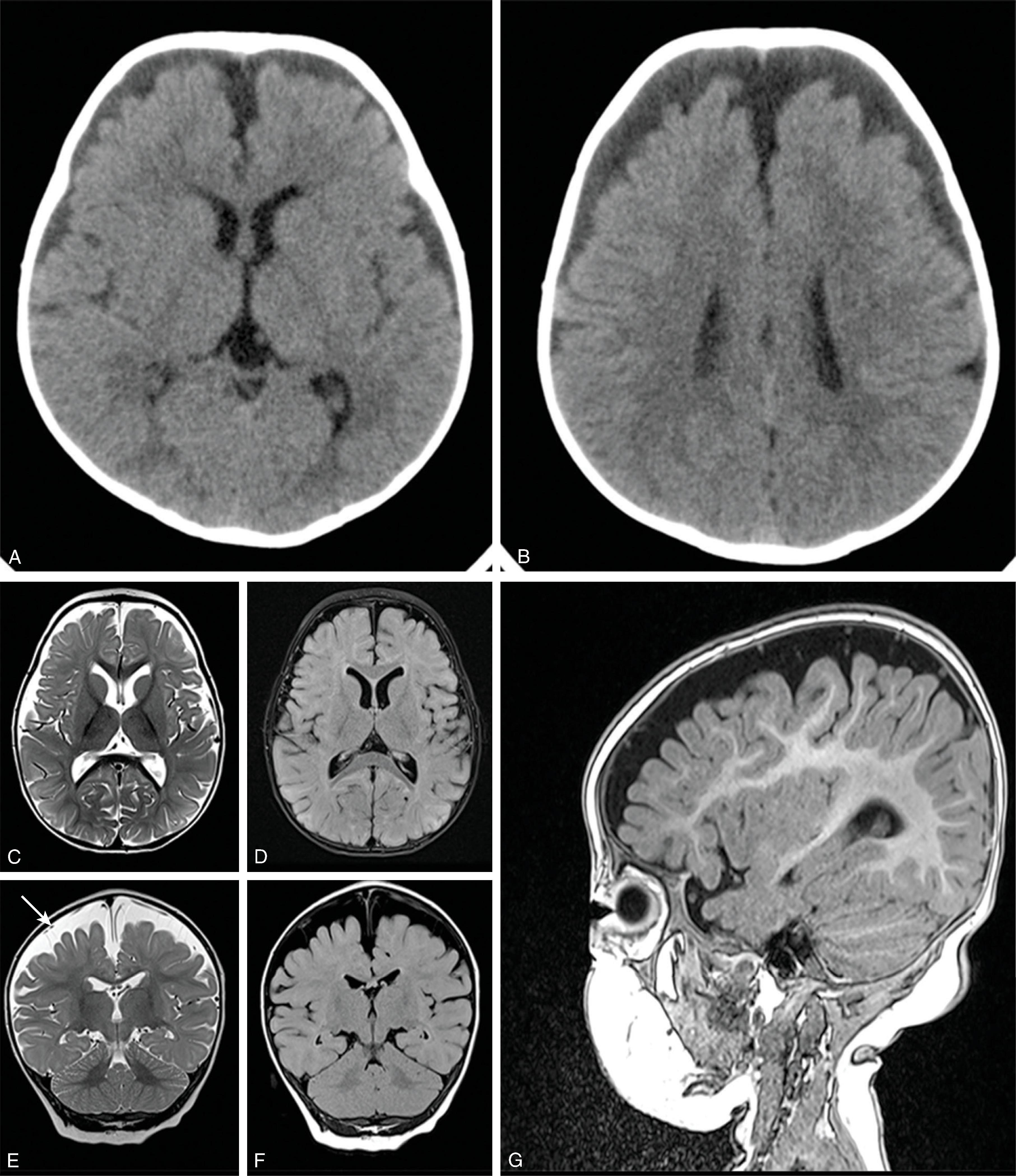 Fig. 11.25, Benign Enlargement of Subarachnoid Spaces . (A and B) Axial head CT images with enlarged extraaxial spaces. (C and E) Axial and coronal T2W, (D and F) axial and coronal FLAIR, and (G) sagittal T1W images with enlarged subarachnoid spaces as indicated by the cortical vessels closely opposed to the inner table of the calvarium. FLAIR images are useful in this setting for increasing sensitivity for detection of a subdural fluid collection.