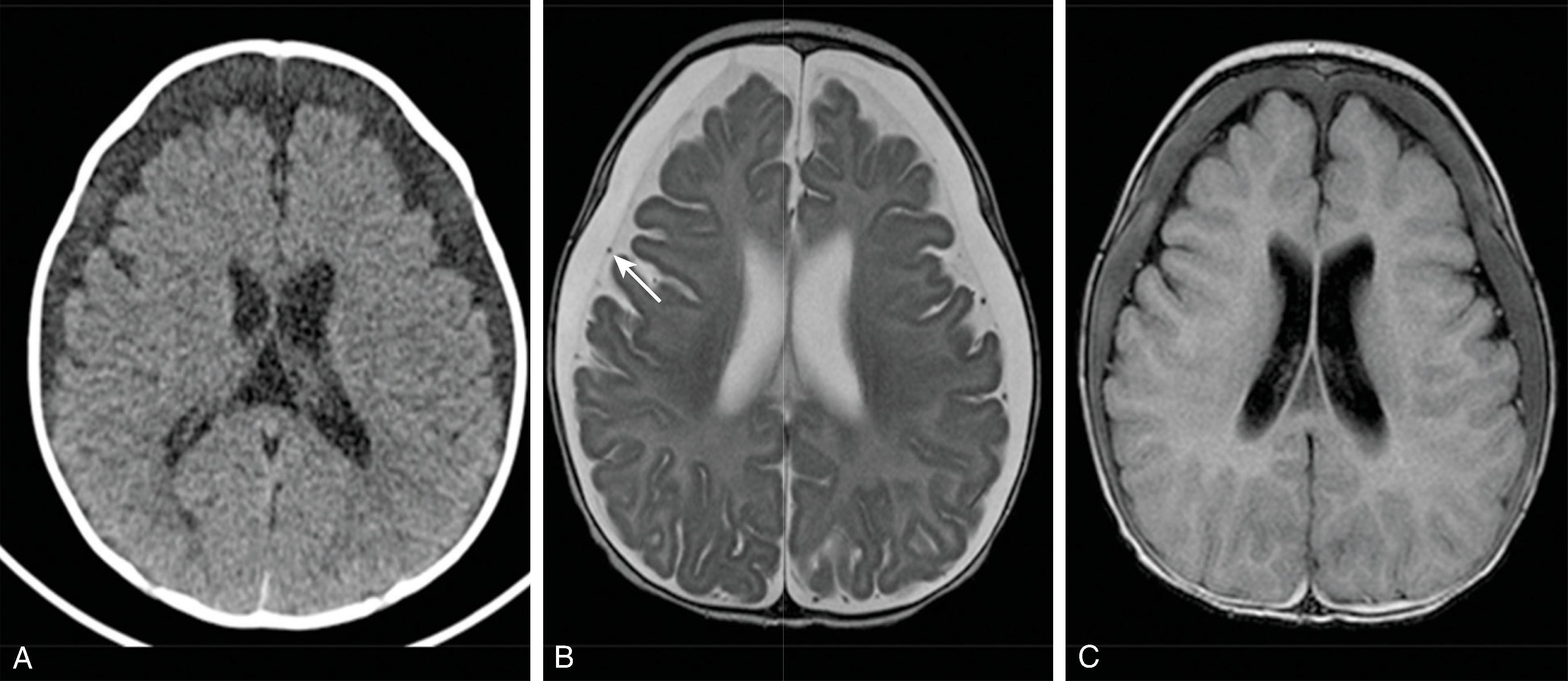 Fig. 11.26, Pitfall in Diagnosis of Benign Enlargement of Subarachnoidal Spaces in Infancy (BESSI): Subdural Fluid Collections . (A) Axial head CT with enlargement of the extraaxial spaces along the frontal lobes, which are proven to be bilateral subdural fluid collections using MRI with (B) axial T2W, and (C) axial FLAIR images that demonstrate the cortical vessels displaced inward, visible dural lining of the subdural collection, and the subdural fluid has higher signal intensity than normal CSF on FLAIR image. These finding should raise concern for potential abusive head trauma.