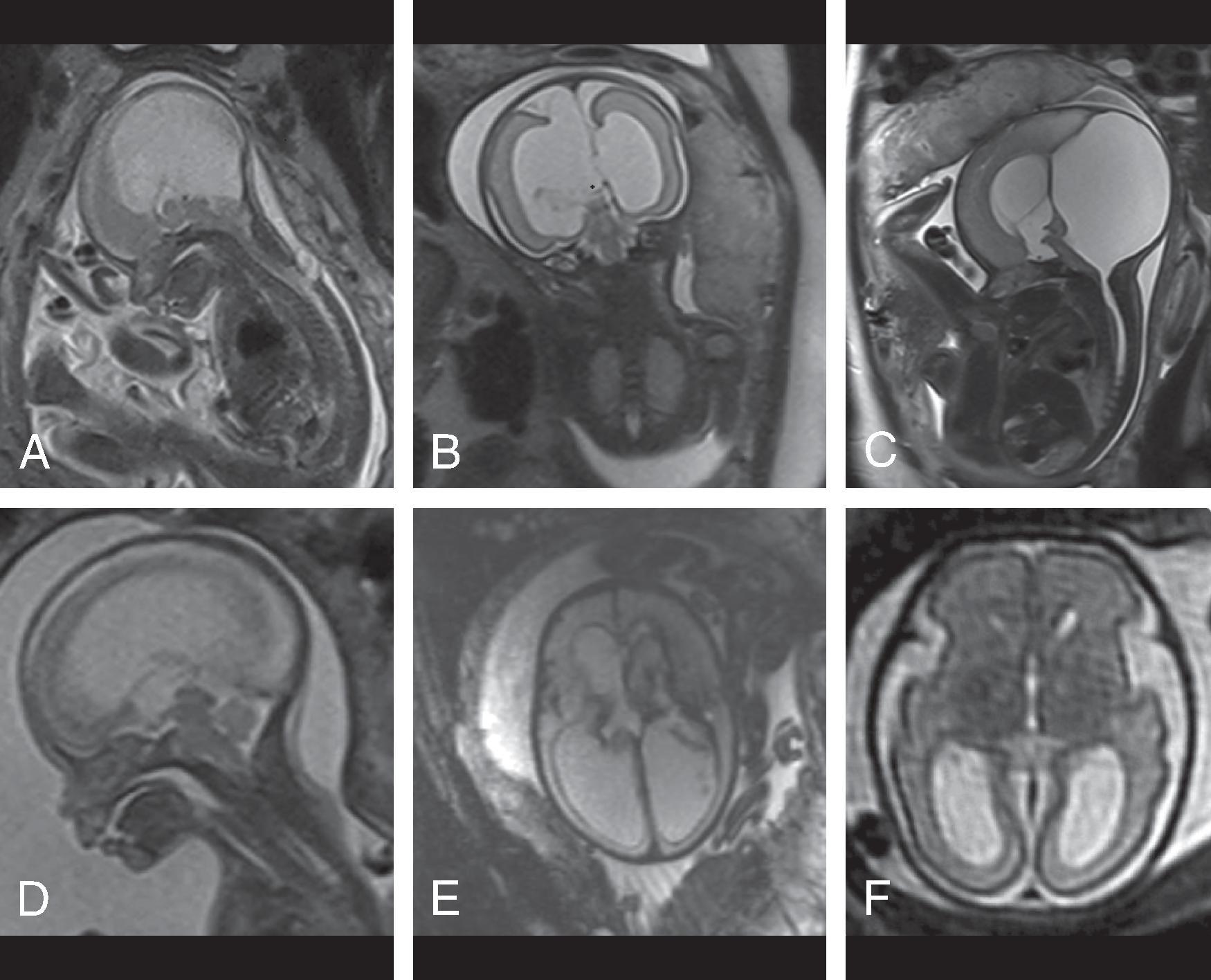 Fig. 11.4, Fetal Ventriculomegaly . Among the many causes for fetal ventriculomegaly include (A) myelomeningocele and Chiari II, (B) callosal agenesis with interhemispheric cyst, (C) Dandy-Walker malformation, (D) aqueductal stenosis, (E) intraventricular hemorrhage, and (F) isolated bilateral ventriculomegaly (when no additional abnormalities are present).