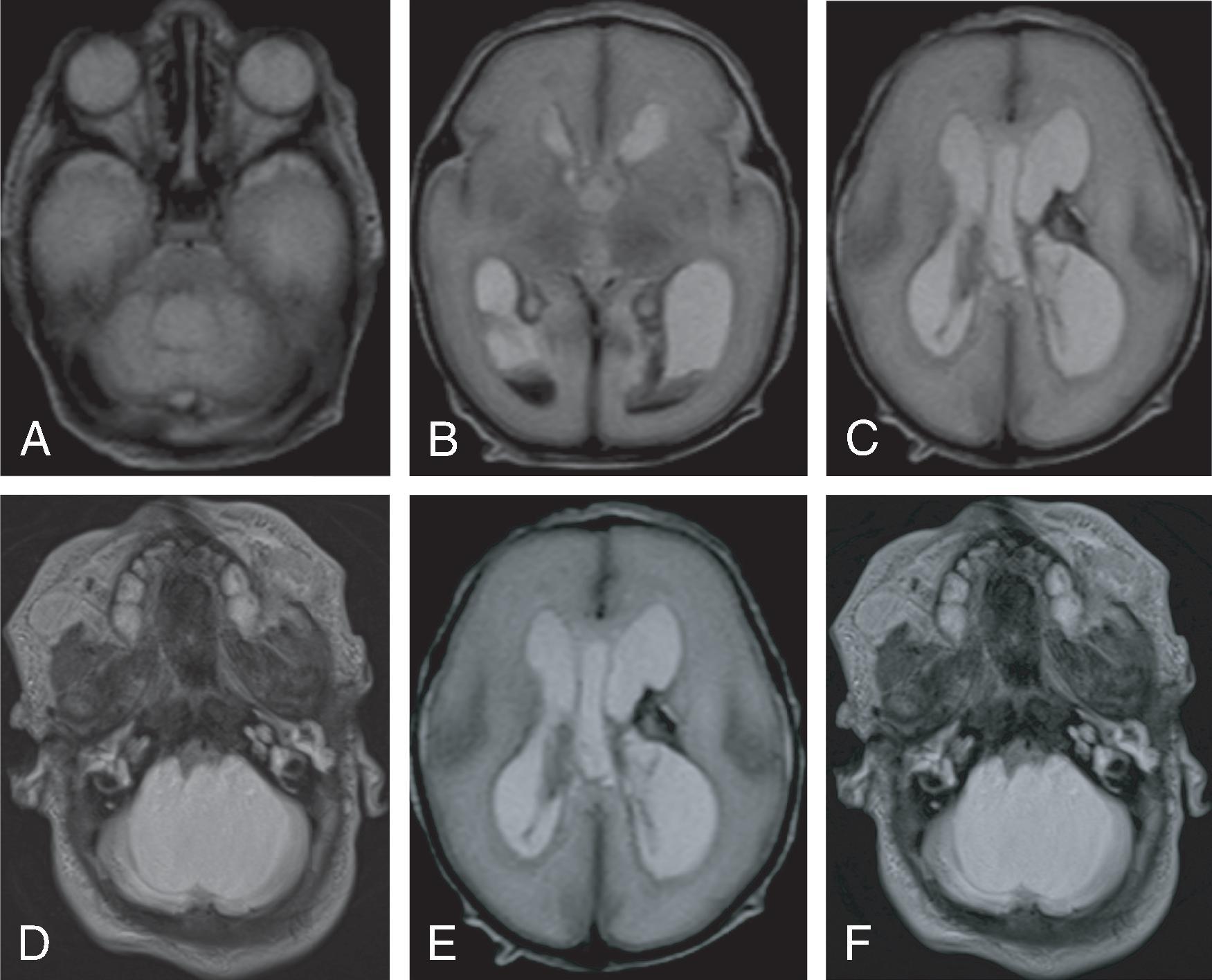 Fig. 11.5, Hydrocephalus Secondary to Hemorrhage . A 26-week premature infant with germinal matrix and intraventricular hemorrhage. (A to C) Axial T2W images demonstrate hypointense areas of hemorrhage within the ventricles, left caudothalamic groove, and periventricular white matter and mild enlargement of the ventricles. (D to F) Axial T2W images on 2-month follow-up MRI demonstrate hydrocephalus of all the ventricles, compressed subarachnoid spaces, intraventricular adhesions, and ventricular diverticulations from the lateral ventricles.