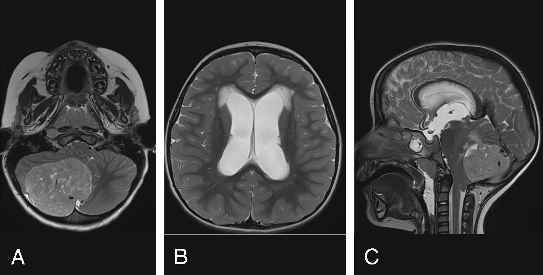 Fig. 11.6, Hydrocephalus Secondary to Tumor Obstruction . (A to C) Axial and sagittal T2W images in a 3-year-old with medulloblastoma with tumor compressing the fourth ventricle and obstructing CSF outflow resulting in acute obstructive hydrocephalus of the lateral ventricles and third ventricle with periventricular edema.