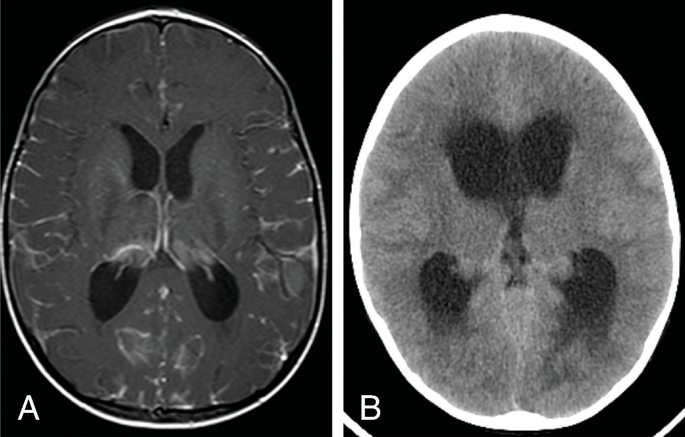 Fig. 11.7, Hydrocephalus Secondary to Leptomeningeal Carcinomatosis . A 3-year-old with medulloblastoma found to have abnormal leptomeningeal enhancement on axial T1W+C (A) and 7 days later developed enlarged ventricles with interstitial edema seen on (B) axial head CT.