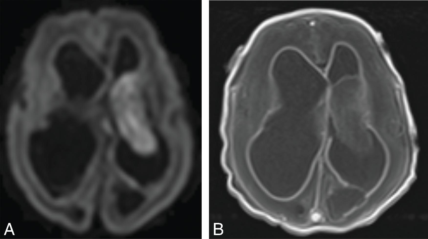 Fig. 11.8, Hydrocephalus Secondary to Meningitis . A 1-month-old with E. coli meningitis. (A) Axial DWI and (B) axial T1W+C images demonstrate intraventricular purulent material, ependymal enhancement, intraventricular adhesion in the posterior left lateral ventricle, and hydrocephalus of the lateral ventricles.