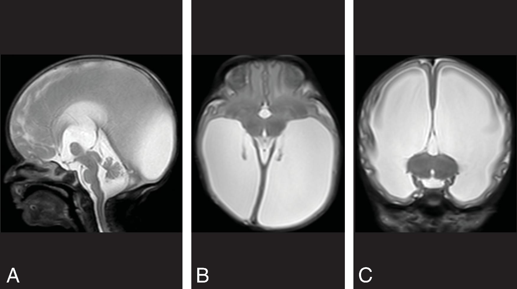 Fig. 11.9, X-linked Hydrocephalus/CRASH Syndrome/L1 Syndrome. A newborn with macrocephaly, spasticity, and adducted thumbs . (A to C) Sagittal, axial, and coronal T2W images demonstrate enlarged lateral ventricles, compressed subarachnoid spaces, fused thalami, dysmorphic midbrain, and aqueductal stenosis. This is a rare syndrome affecting 1 in 30,000 males caused by genetic mutations of the L1CAM gene and presents with prenatal hydrocephalus, aqueductal stenosis, corpus callosum hypoplasia/agenesis, adducted thumbs, spasticity, and mild to moderate intellectual disability. Additional findings can include fused thalami, abnormal brainstem, and small corticospinal tracts.