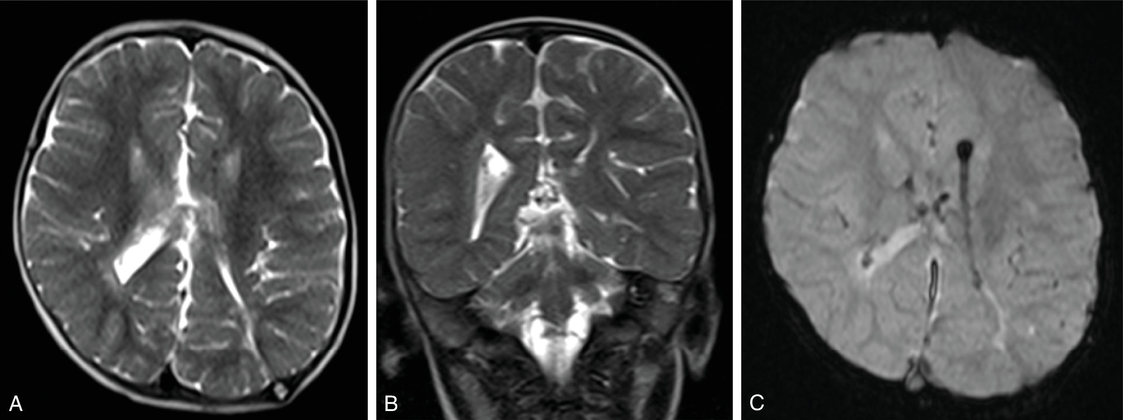 Fig. 11.11, Ultrafast MRI for Shunt Evaluation . (A and B) Ultrafast axial and coronal T2 HASTE images of the brain demonstrate the decompressed ventricles and (C) echo-planar T2* image demonstrates the catheter position. Ultrafast MRI can reduce the use of CT for evaluating ventricle size and are faster than standard MRI sequences, which can reduce need for sedation.