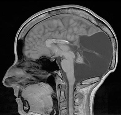 Figure 60.3, Sagittal T2 MRI scan of a patient with Dandy-Walker syndrome.