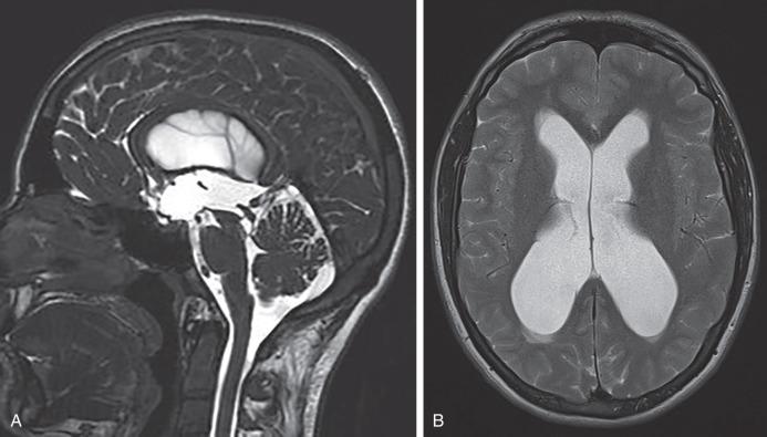 Figure 60.4, (A) Sagittal CISS sequence MRI scan of a patient with aqueduct stenosis. (B) Axial T2 sequence MRI scan of the same patient showing ventriculomegaly.