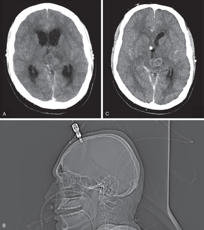 Figure 60.5, (A) CT scan with contrast of a patient with acute hydrocephalus caused by thalamic lesion blocking the third ventricle. (B) Lateral skull x-ray showing the bolt EVD inserted for the same patient. (C) CT scan of the brain of the same patient following an emergency external ventricular drain insertion. Tip of the EVD is visible at the right foramen of Monro.