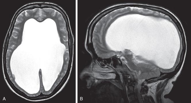 Figure 60.6, (A) Axial T2 and (B) sagittal MRI scan of a patient with LOVA.