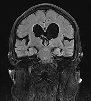 Figure 60.7, Coronal T2 MRI scan of a normal pressure hydrocephalus patient with narrow callosal angle and DESH sign.