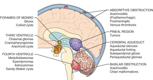 Figure 8.3, Illustration of common sites of CSF obstruction.