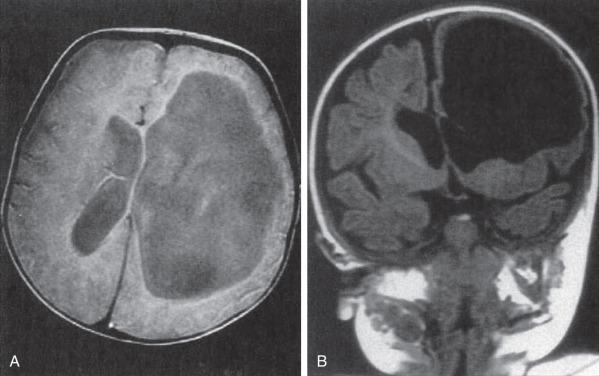 Figure 8.4, CT scan showing hydrocephalus due to occlusion of the left foramen of Monro.