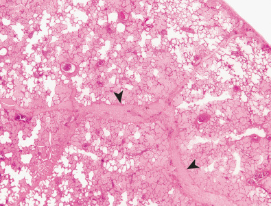 Fig. 54.1, Pathologic findings of pulmonary edema. Histologic specimen shows thickening of the interlobular septa (arrowheads) and partial filling of the airspaces by fluid .