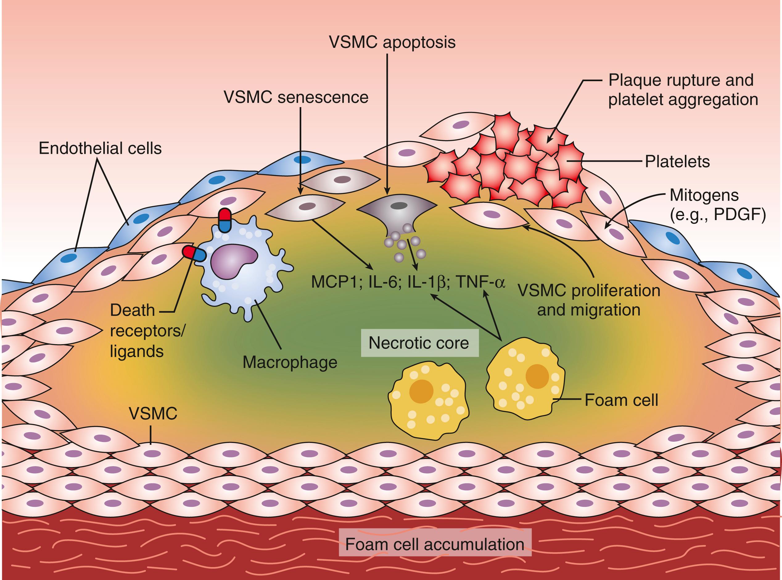 Figure 13.4, Interaction of cellular elements to form the lipid core and fibrous cap.