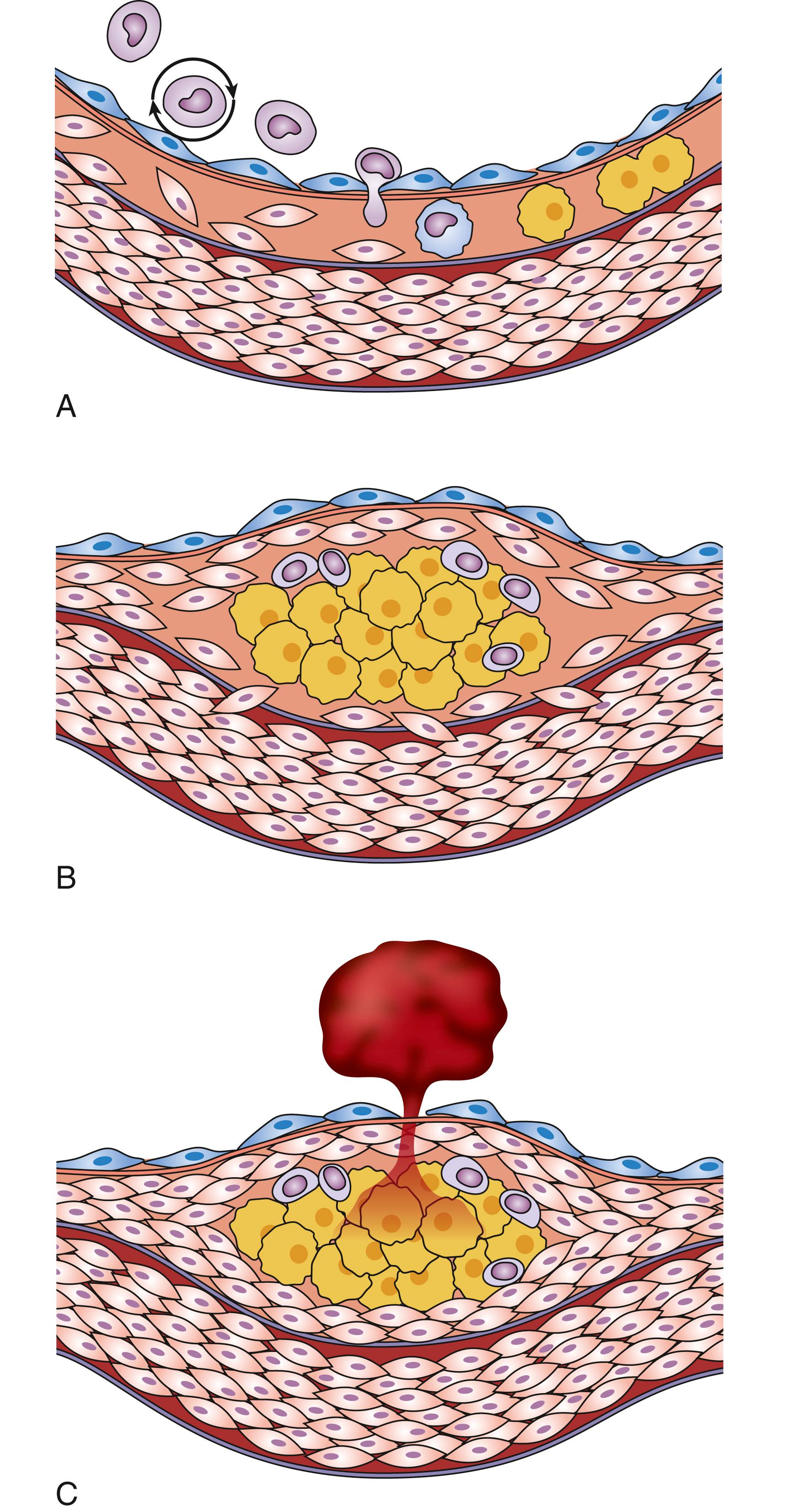 Figure 13.6, Initiation of plaque: the stable versus vulnerable plaque. ( A ) Recruitment of leucocytes in a developing plaque. ( B ) T-lymphocytes and macrophages in the intima and plaque formation. ( C ) Plaque rupture and thrombus formation, may lead to vessel occlusion.