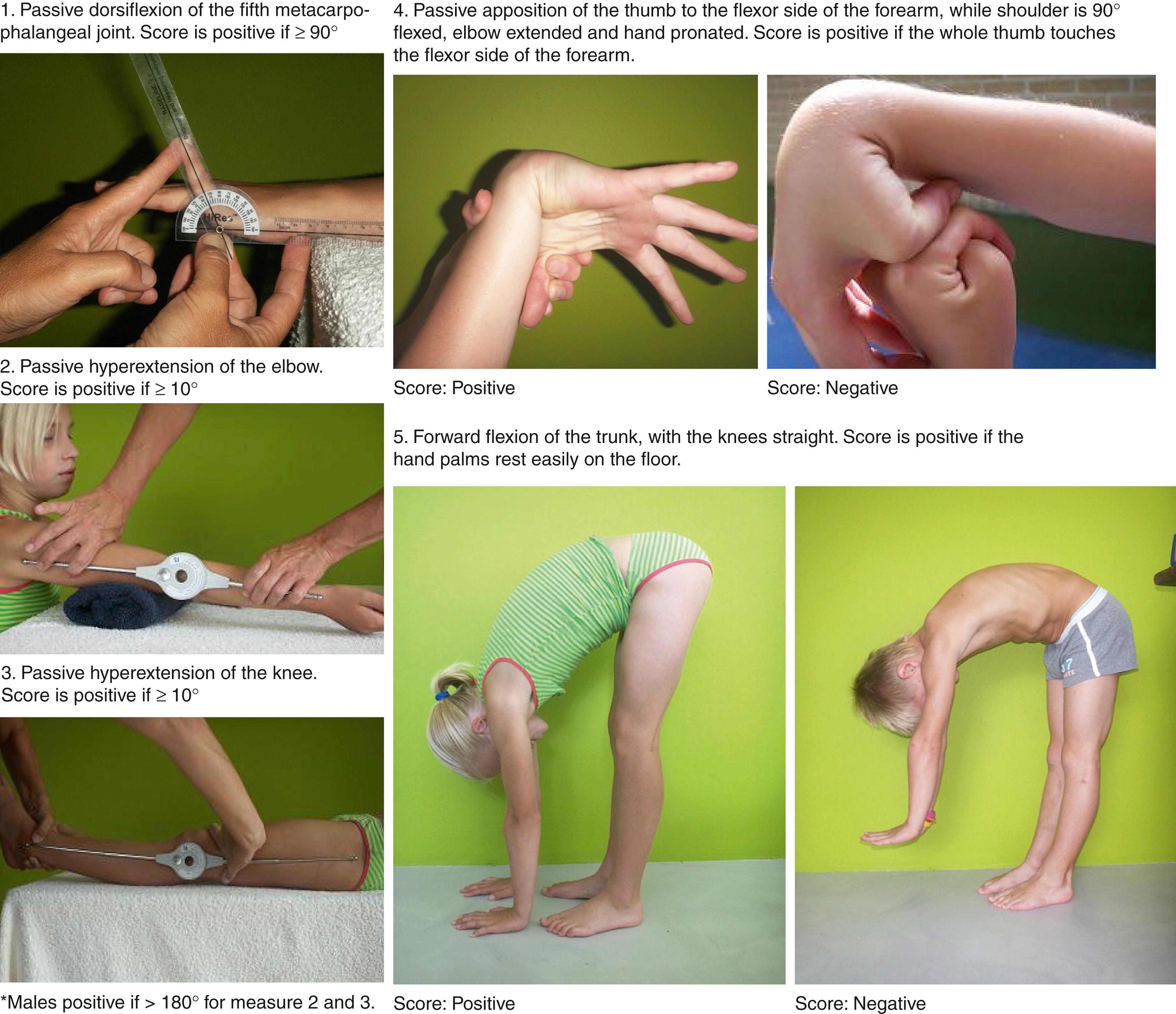 Fig. 47.2, Beighton score. The range of motion of several key small and large joints is measured to provide an overview of joint hypermobility. Instability is not assessed. Scoring: 2 points for each bilateral measure in nos. 1 to 4 and 1 point for no. 5 , equaling a total possible score of 9. Hypermobility is considered significant with a score of ≥6 between the ages of 6 and 35.