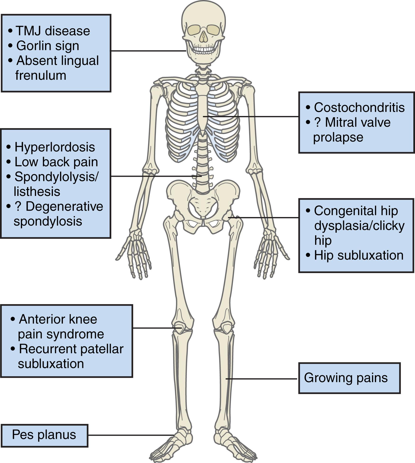 Fig. 47.3, Clinical features and symptom complexes seen in children and adolescents with joint hypermobility syndrome. TMJ, temporomandibular joint.