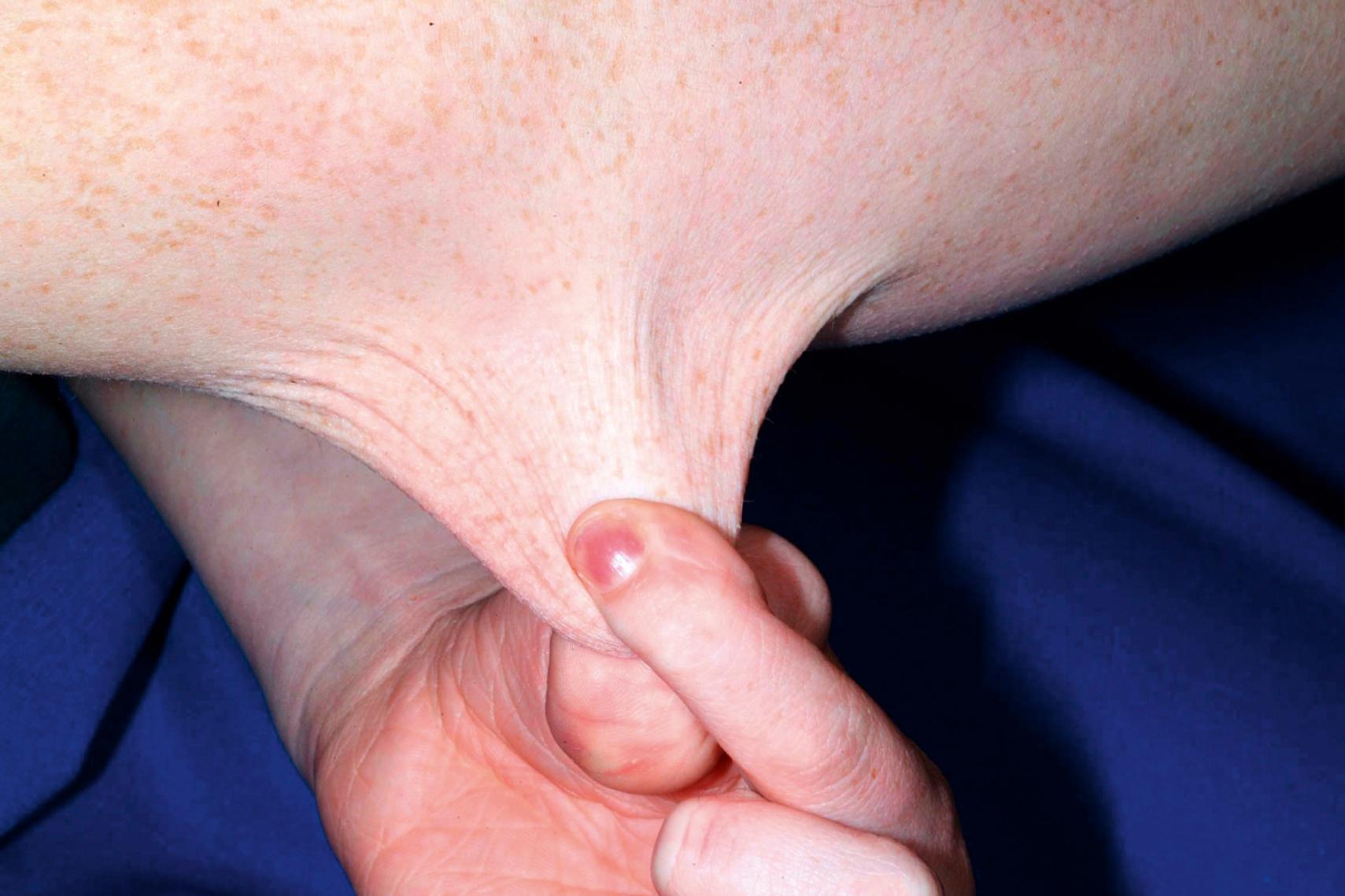 Fig. 47.5, Ehlers-Danlos syndrome. Skin hyperextensibility on the arm. This sign does not demonstrate laxity because on release the skin quickly returns to normal.