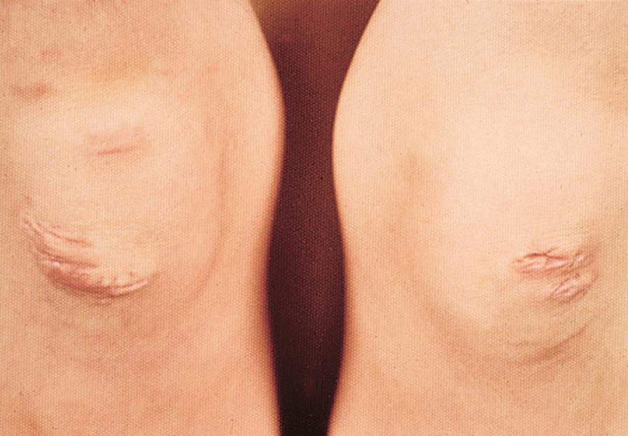 Fig. 47.6, Large “cigarette paper” scars on the knees of a child with Ehlers-Danlos type 1.