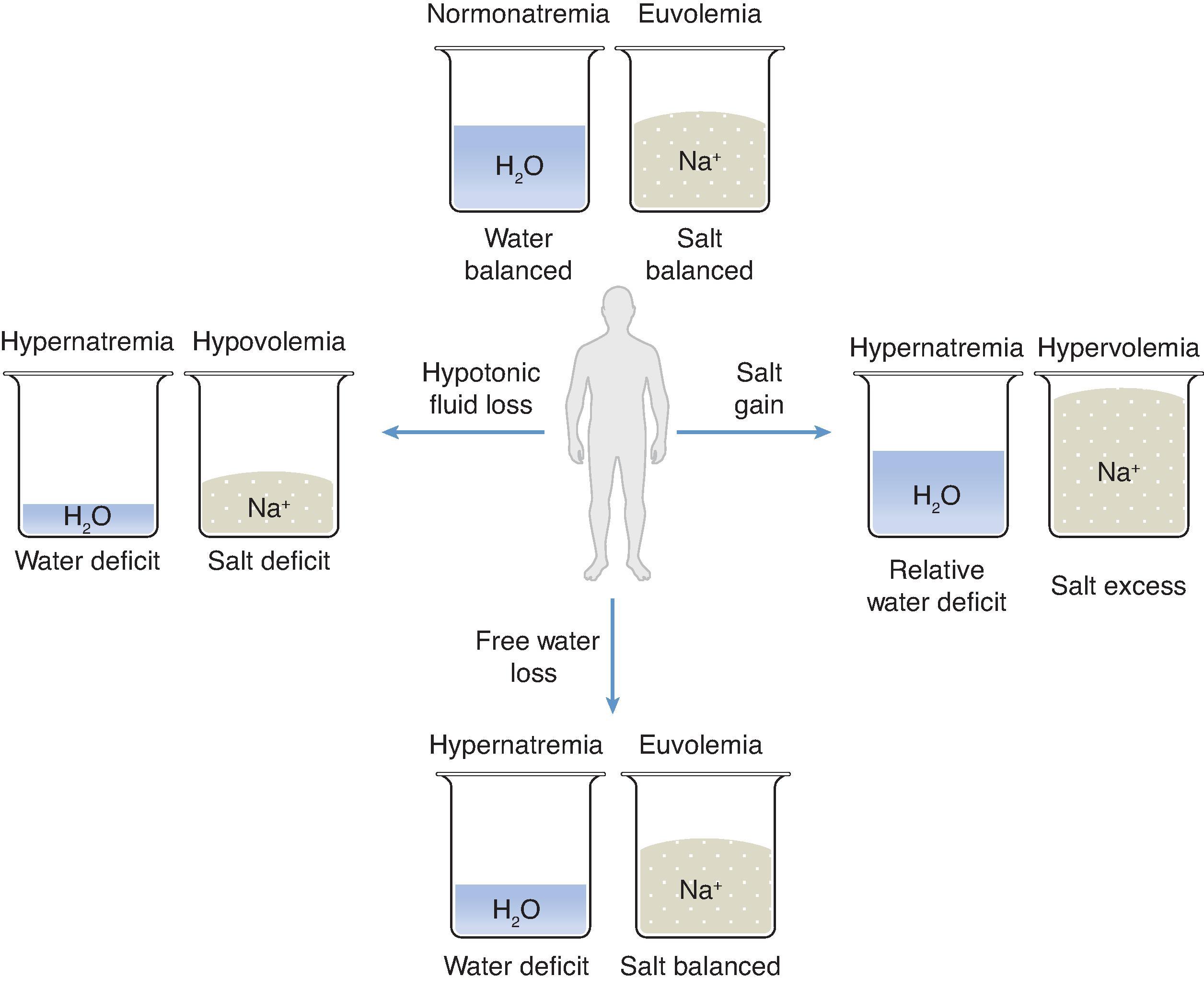 Fig. 8.1, Diagnostic approach to hypernatremia. The pathophysiology of hypernatremia is best understood by separating water and salt balance, done so here by theoretical beakers. Water balance determines the serum sodium concentration, whereas salt balance determines volume status. The beakers at the top of the figure represent normal physiology with water and salt in balance. In the three remaining cases of hypernatremia there is a water deficit with varying degrees of salt balance or volume status. Refer to Table 8.1 for further details regarding the specific causes of hypernatremia for each group of salt balance.