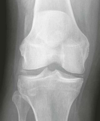 eFIGURE 78–2, Chondrocalcinosis in a patient with primary hyperparathyroidism showing well-preserved femorotibial joint space and without signs of degenerative joint disease.