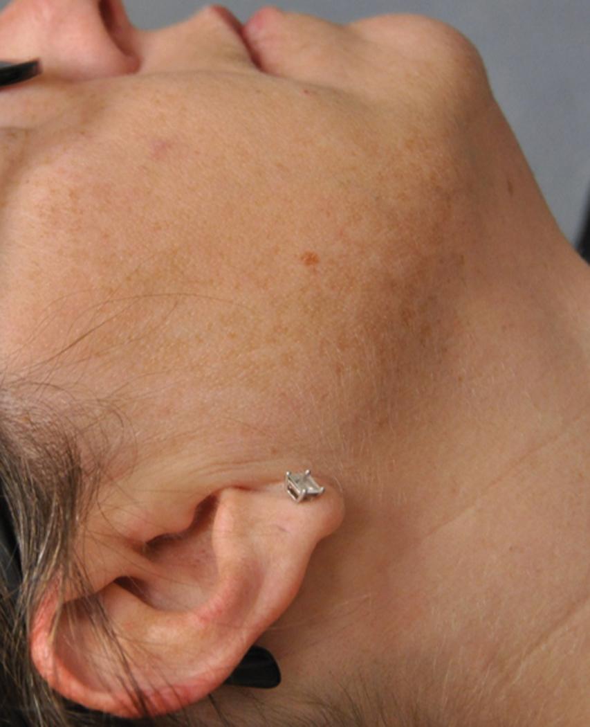 Fig. 7.1, Melasma, Right Cheek.