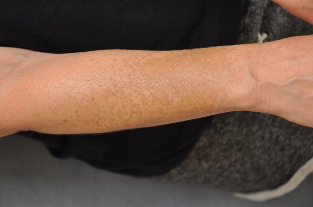 Fig. 7.2, Melasma, Forearm.