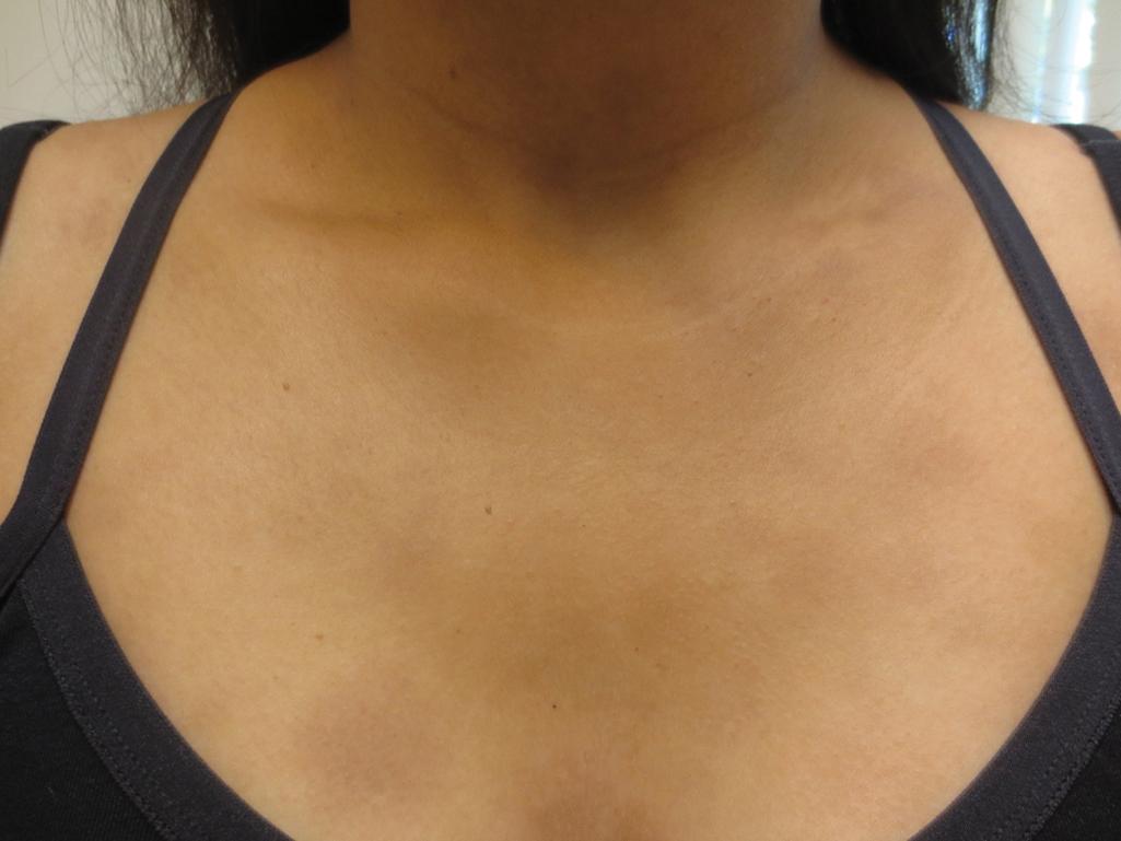 Fig. 7.3, Erythema Dyschromicum Perstans.