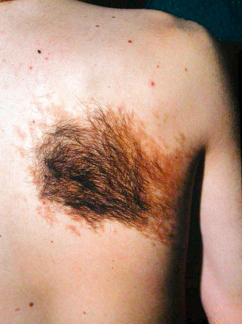 Fig. 70.3, Becker melanosis (nevus) on the mid back in a young man.