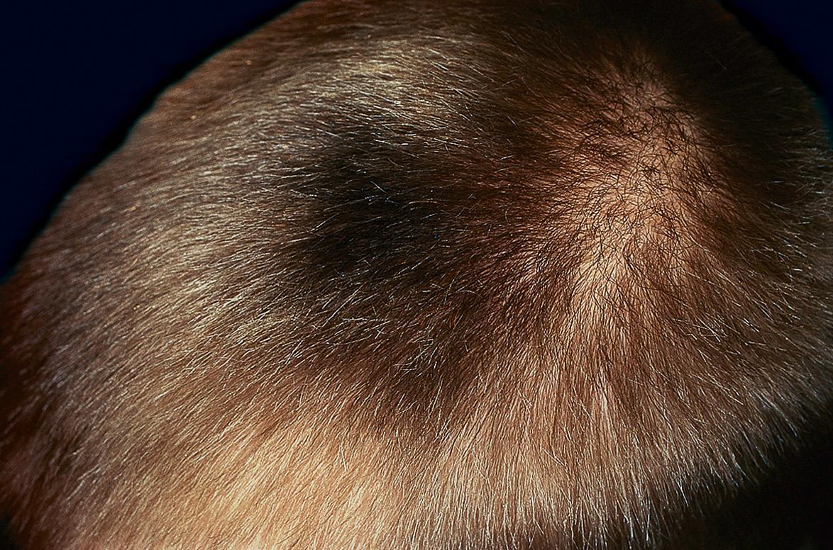 Fig. 70.4, Nevoid hypertrichosis (nevus pilosus) of the scalp in a young boy.