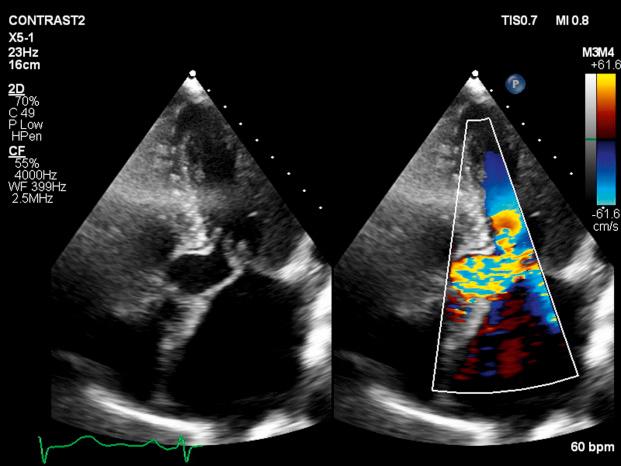 Fig. 58.1, Posteriorly directed mitral regurgitation accompanying systolic anterior motion of the anterior mitral leaflet in hypertrophic cardiomyopathy, visualized with two-dimensional and Doppler echocardiography.