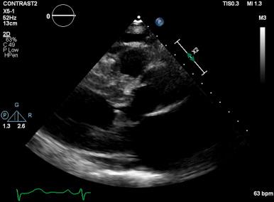 Fig. 58.2, Systolic anterior motion of the mitral valve visualized with two-dimensional echocardiography in the parasternal long axis.