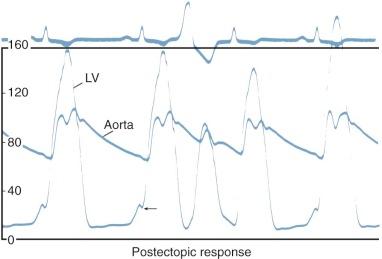 Figure 19-7, Left ventricular (LV) and aortic pressure tracings in hypertrophic obstructive cardiomyopathy (HOCM). Peak systolic gradient is 60 mmHg. Aortic pressure pulse shows typical double contour (“spike and dome”). LV end-diastolic pressure is elevated in association with transmission of an a wave from the left atrium (arrow) . The beat after an ectopic beat demonstrates reduced aortic pulse pressure characteristic of HOCM (center of tracing) .