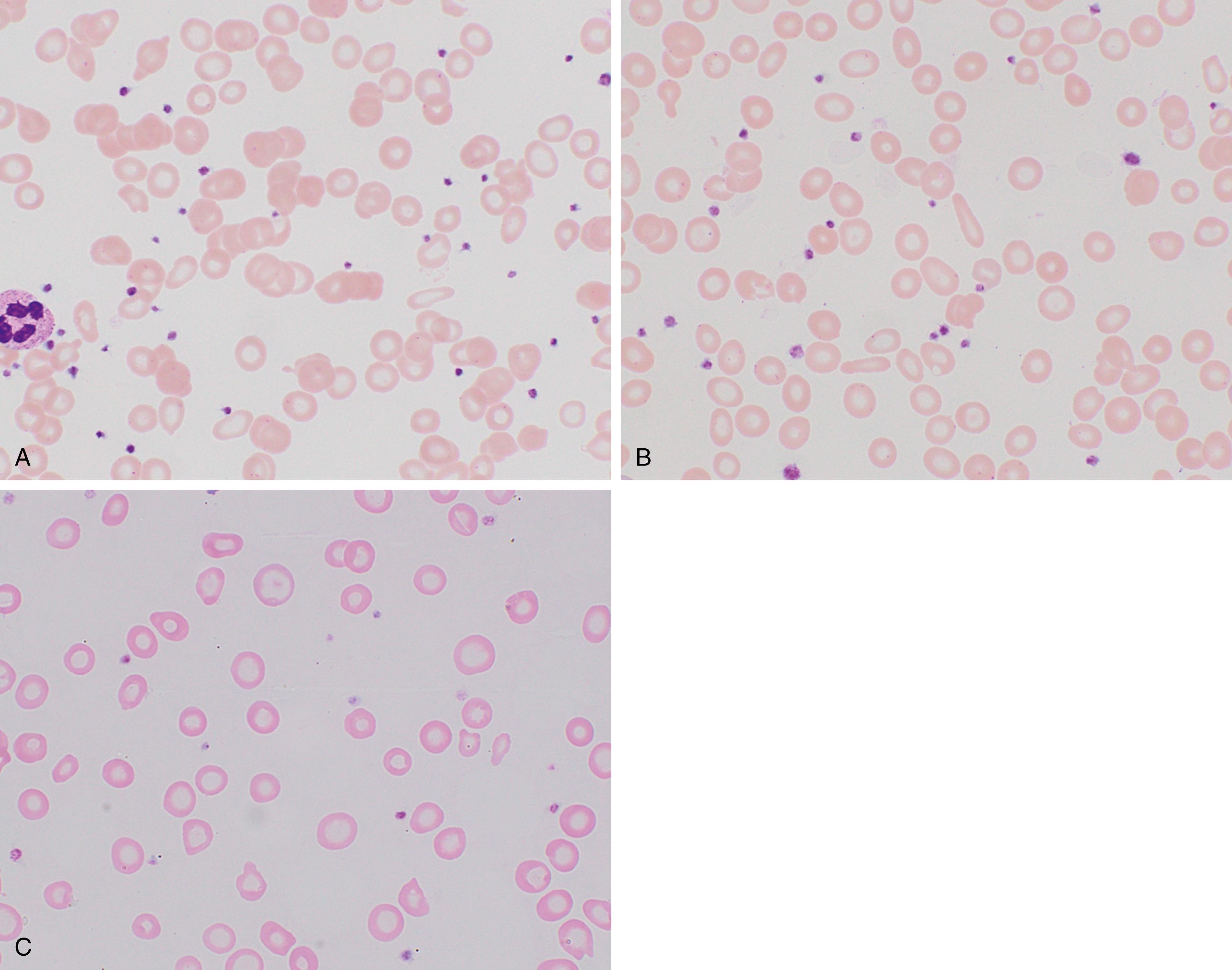 Fig. 3.1, Iron deficiency anemia.