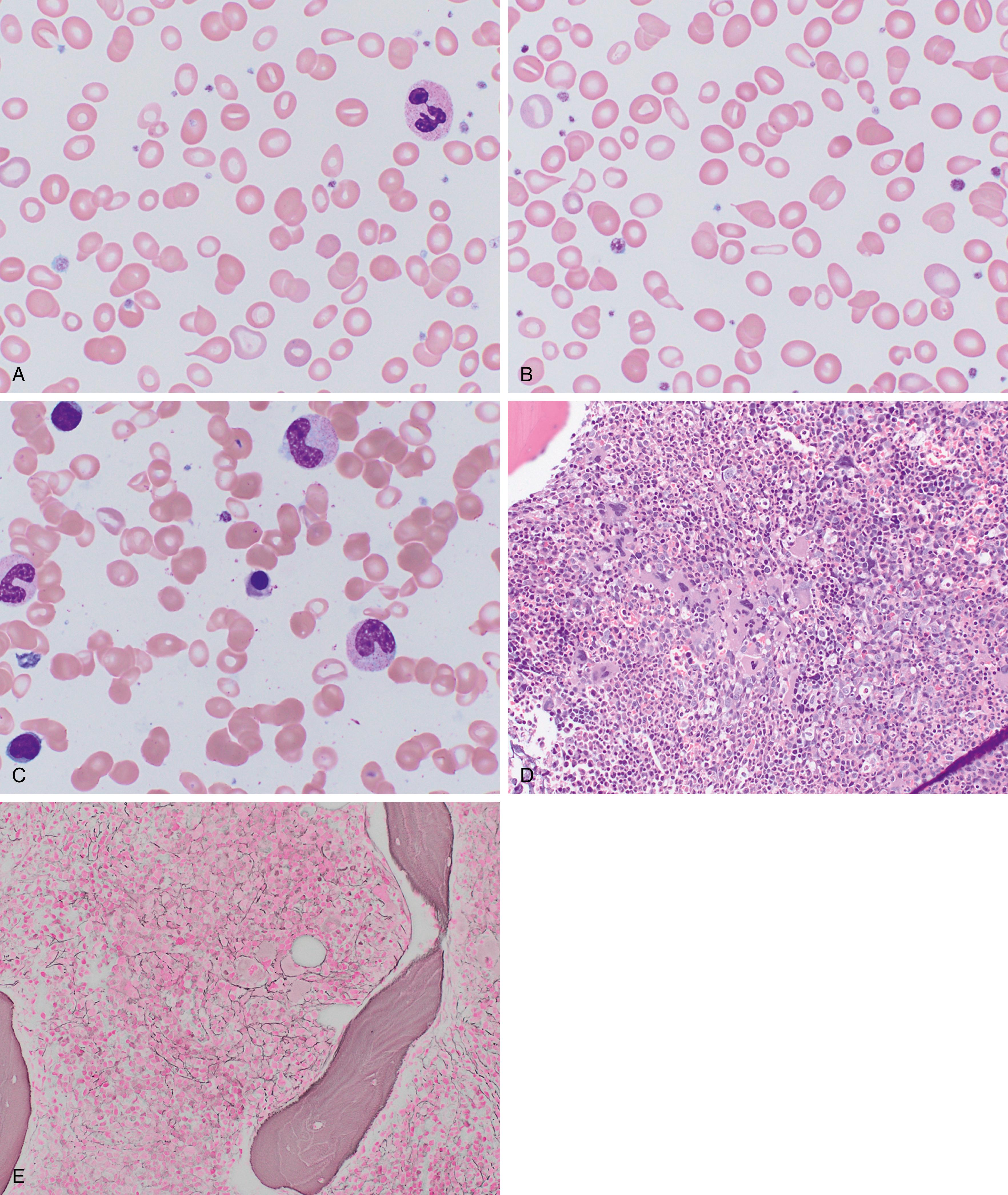Fig. 3.2, Severe iron deficiency complicating the presentation of polycythemia vera, spent phase.