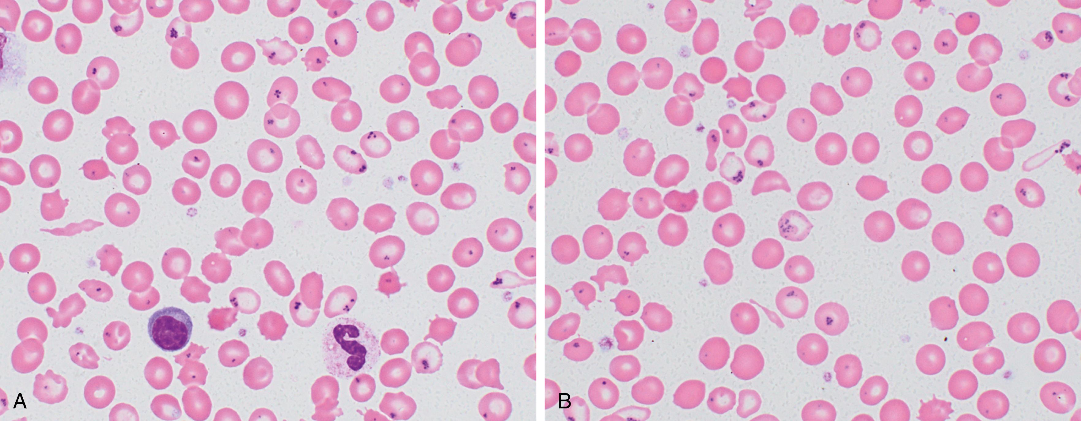 Fig. 3.3, Hereditary sideroblastic anemia.